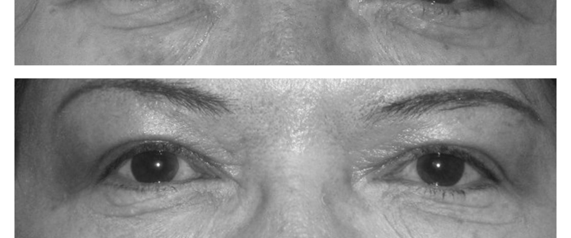 treating-botox-ptosis-a-comprehensive-guide