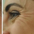 What Areas is Botox Best For?