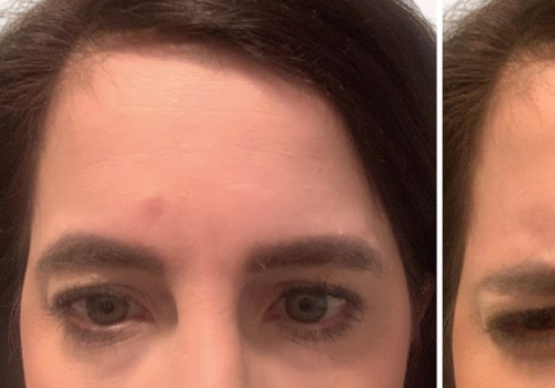 What Happens When Botox Wears Off?