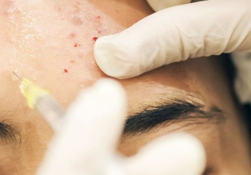 Should I Get Botox for Acne Treatment?