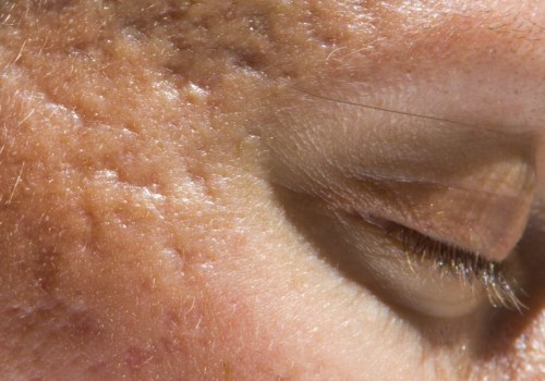 Can Botox Treat Acne? An Expert's Perspective