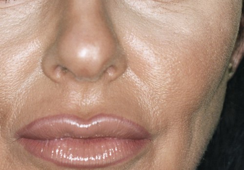 Can Botox Be Used Anywhere?